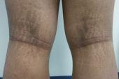 Graphical Abstract of Acanthosis nigricans in obese adolescents: prevalence, impact, and management challenges