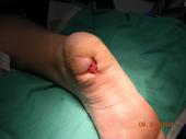 Graphical Abstract of Bilayered skin-substitute technology for the treatment of diabetic foot ulcers: current insights