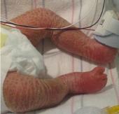 Graphical Abstract of Neonatal erythroderma &ndash; clinical perspectives