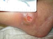 Graphical Abstract of Combined ultrasound and electric field stimulation prompts an immediate response in stalled chronic wounds