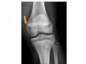 Graphical Abstract of Evaluation, management and prevention of lower extremity youth ice hockey injuries