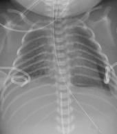 Graphical Abstract of Congenital chylothorax: current perspectives and trends