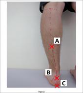 Graphical Abstract of High lateral plantar pressure is related to an increased tibialis anterior/fibularis longus activity ratio in patients with recurrent lateral ankle sprain