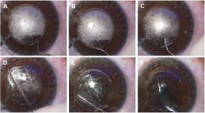 Small incision lenticule extraction (SMILE) techniques: patient select ...