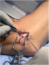 Graphical Abstract of Chronic lateral epicondylitis: challenges and solutions