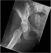 Graphical Abstract of Bilateral femoroacetabular impingement syndrome managed with different approaches: a case report