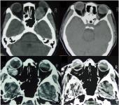 Graphical Abstract of Surgical outcome of orbital cavernous hemangioma: a case series