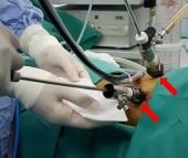 Graphical Abstract of Port-less technique (PLT) in pediatric video-assisted thoracoscopic surgery (VATS): a 10-year experience at National University of Malaysia