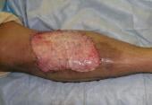Graphical Abstract of Wound care matrices for chronic leg ulcers: role in therapy