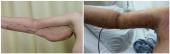 Graphical Abstract of Removal of excess skin after massive weight loss: challenges and solutions