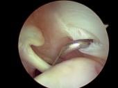 Graphical Abstract of Magnetic resonance imaging arthrography following type II superior labrum from anterior to posterior repair: interobserver and intraobserver reliability
