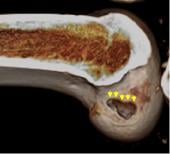 Graphical Abstract of Evaluating the distance between the femoral tunnel centers in anatomic double-bundle anterior cruciate ligament reconstruction using a computer simulation