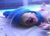 Graphical Abstract of The effect of hat on phototherapy-induced hypocalcemia in jaundiced full-term neonates