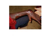 Graphical Abstract of Buruli ulcer: wound care and rehabilitation