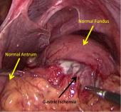 Graphical Abstract of Managing obstructive gastric volvulus: challenges and solutions