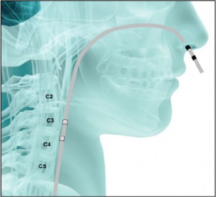 Treating Swallowing Disorders With Neuromuscular Electrical Stimulation