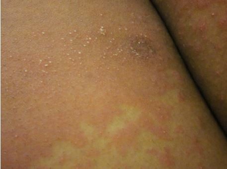 psoriasis cleared up during pregnancy