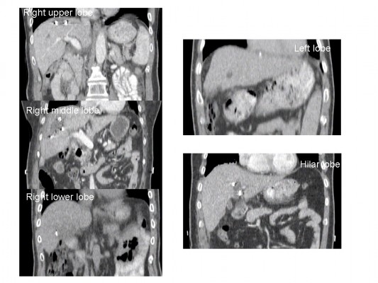Comparison of Liver Tumor Motion With and Without Abdominal