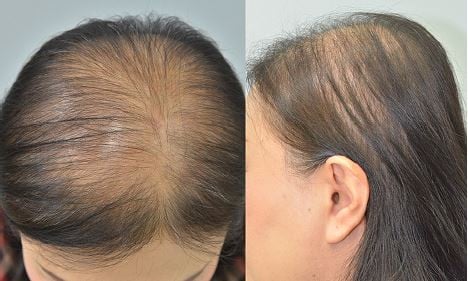 Parietal scalp is another affected area in female pattern hair loss: a |  CCID