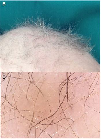 Menkes kinky hair syndrome A case report