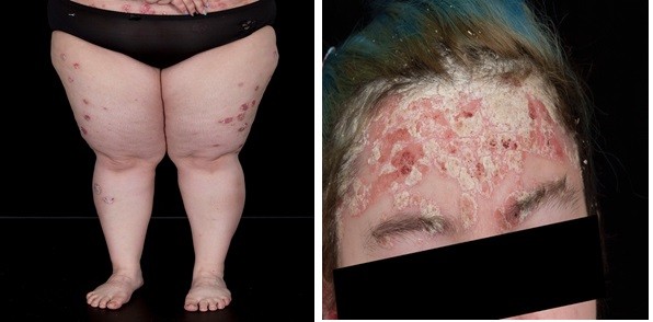 cure for psoriasis on legs)