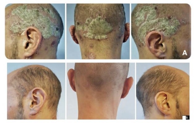 plaque psoriasis scalp pics