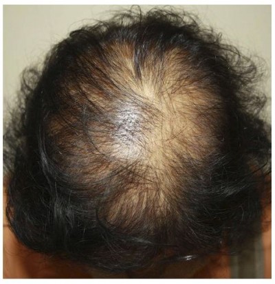 Finasteride and Its Potential for the Treatment of Female Pattern Hair |  DDDT
