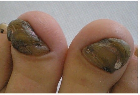 Chloronychia: green nail syndrome caused by Pseudomonas aeruginos | CIA