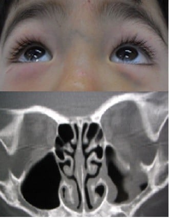 A Case Of Out Fracture The Orbital Floor In Early Childhood Imcrj