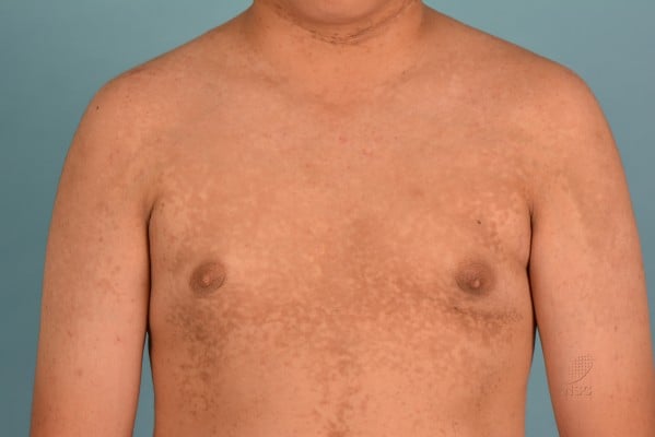 Papillomatosis and skin. Papillomatosis causes