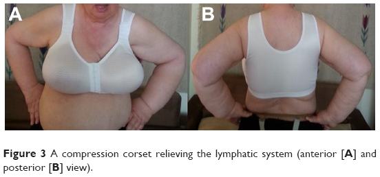 Are compression corsets beneficial for the treatment of breast