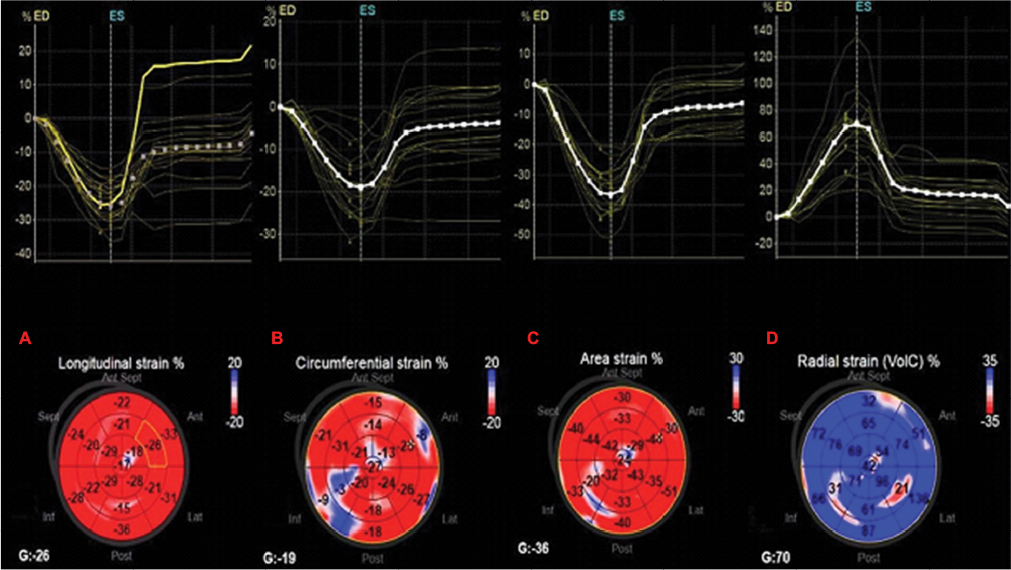 Three and two-dimensional cardiac mechanics by speckle tracking are  predictors of outcomes in chagas heart disease