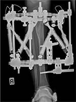Minimally invasive distal tibial osteotomy and correction of deformity with  the Taylor Spatial Frame – Orthoracle LuanMD