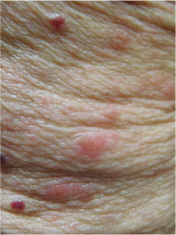 Scabies rash showing extensive involvement. Typical lesions present on