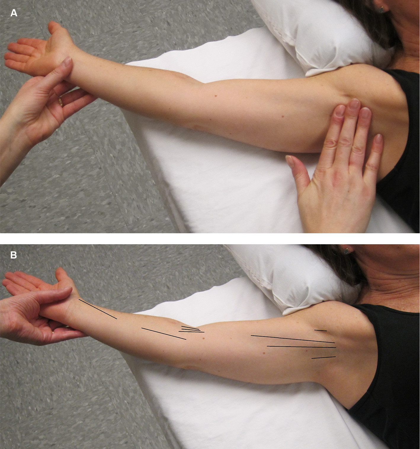 PDF] Lymphatic cording or axillary web syndrome after breast cancer  surgery.
