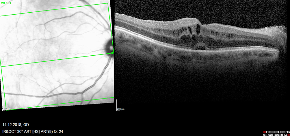 Retinal vascular assessment in psoriatic patients with and without  metabolic syndrome using optical coherence tomography angiography