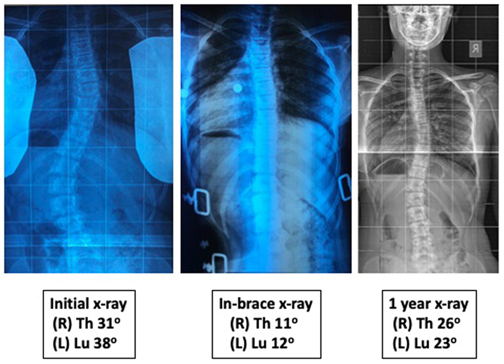 Scoliosis Bracing - Atlanta, GA - Spine Surgery