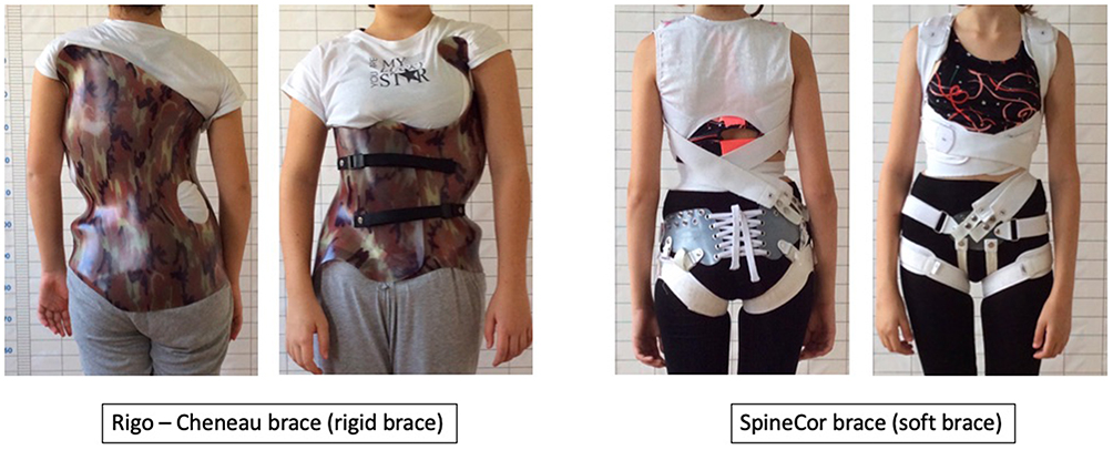 The Wilmington brace is a popular thoracolumbosacral orthosis that