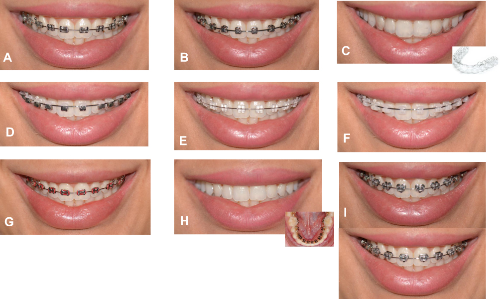 Adult Perceptions of Different Orthodontic Appliances