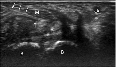 Ultrasound-Guided Corticosteroid Injection in Carpal Tunnel