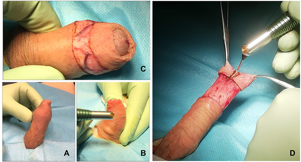Preputioplasty as a surgical alternative in treatment of phimosis
