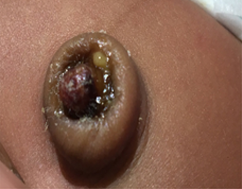 Umbilical Granuloma: Causes, Treatment, Aftercare