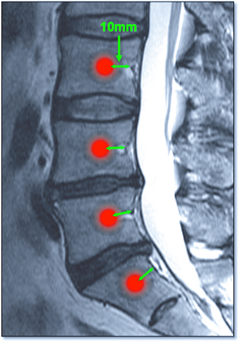 Vertebrogenic (Low Back) Pain: Causes, Diagnosis, Treatment