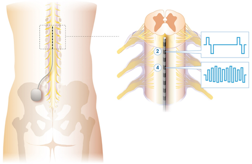 Spinal cord stimulation for the treatment of peripheral