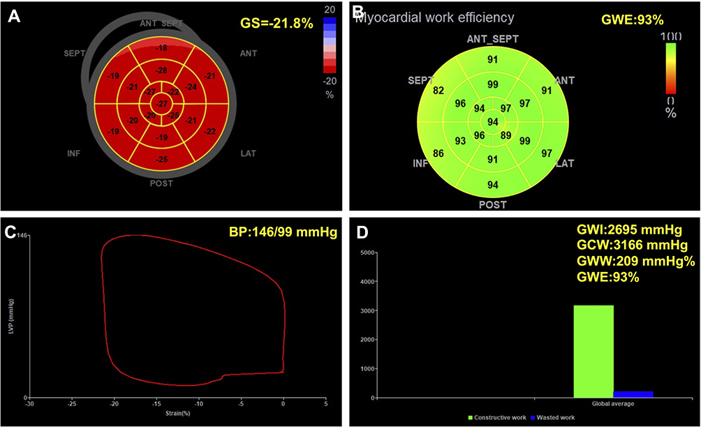 Impact of Pulse Pressure on Indexes of Myocardial work