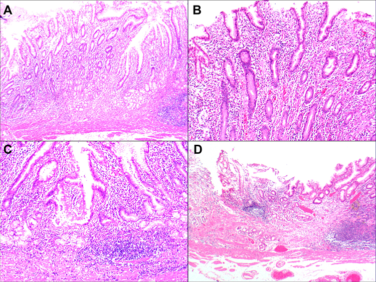 The Etiology of Gastric Mucosal Atrophy