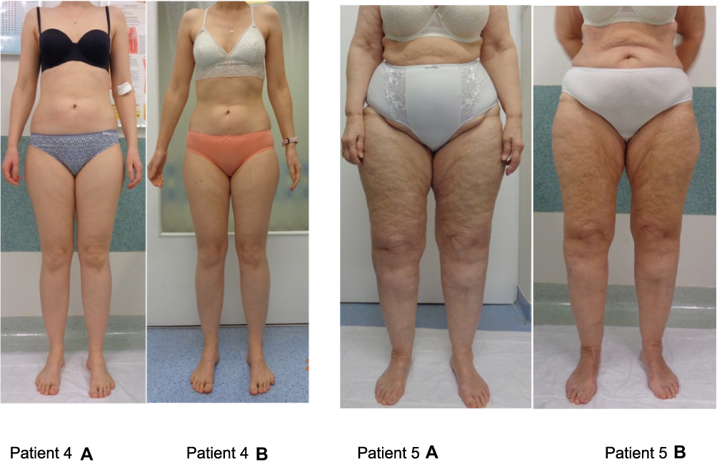 Diets on body composition in patients with lipedema