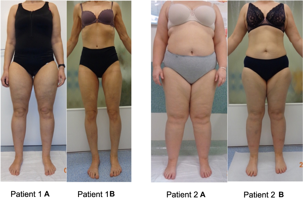 Diets on body composition in patients with lipedema