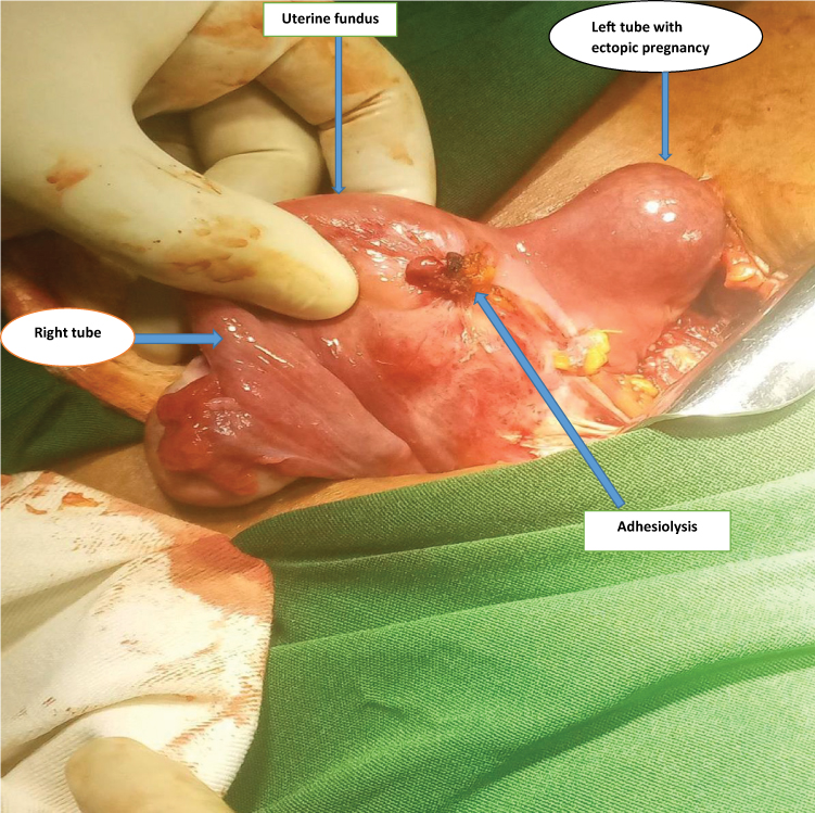 Unilateral Twin Ectopic Pregnancy: A Case Report from the Eastern