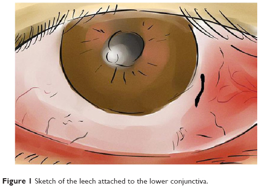 Ocular leech infestation